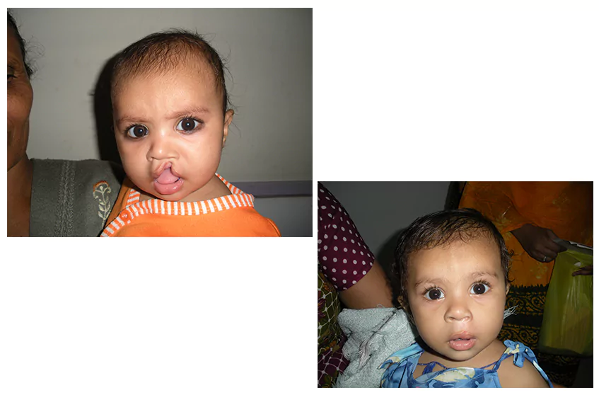 cleft-lip-palate-surgery